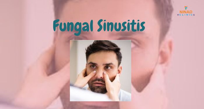 Learn about fungal sinusitis, its causes, symptoms, and treatment options. Expert ENT treatment in PCMC can help manage and cure this condition effectively.